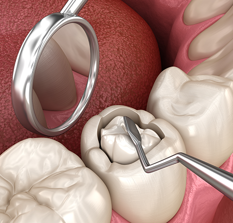 3D image of a tooth receiving a dental filling.